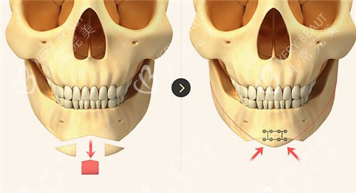 下巴整形环骨骼变化图