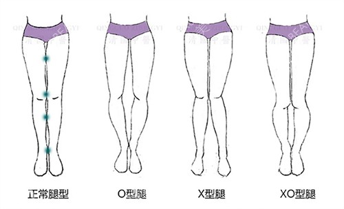 O型腿和X型腿对比图