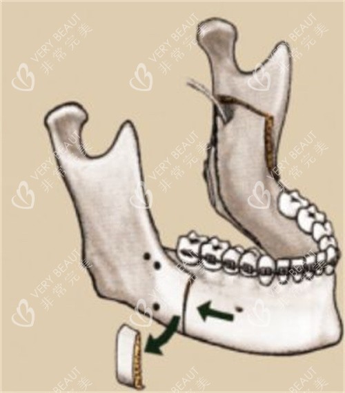 下颌垂直截骨术演示动画图