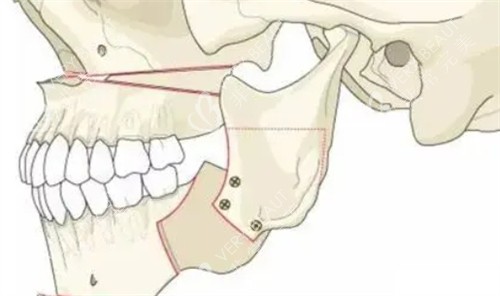 正颌手术后的形状