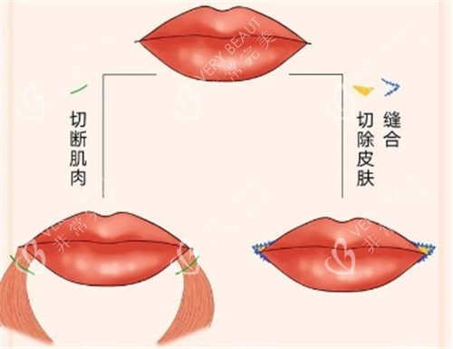 微笑唇整形动画示意图