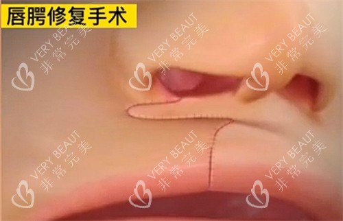 唇裂修复手术即刻形状
