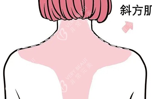 背部卡通示意图