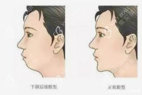 正常脸型和下巴后缩脸型对比图