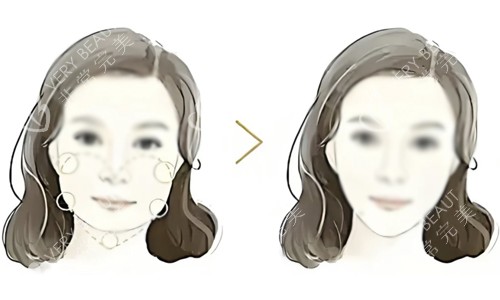 瘦脸对比