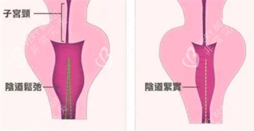生物束带紧缩术对比