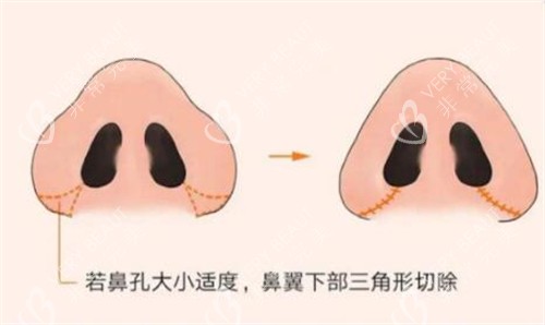 鼻翼缩小改善照片