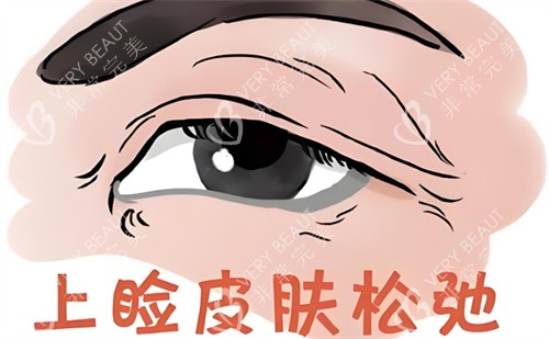中年眼上睑皮肤松弛