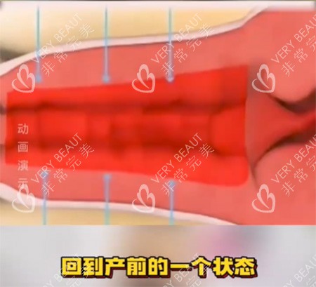 女性私密收紧针照片