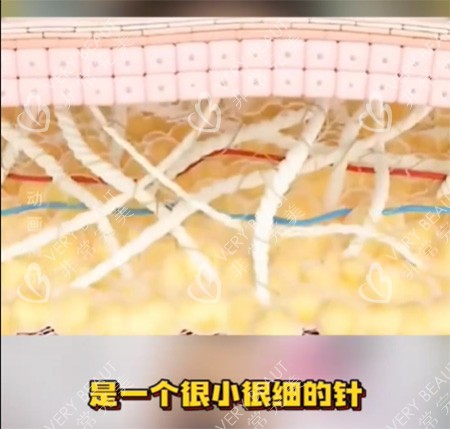 私密紧致针好不好