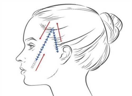 面部埋线卡通示意图