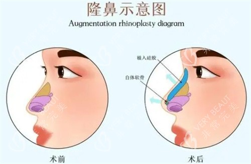 隆鼻前后对比