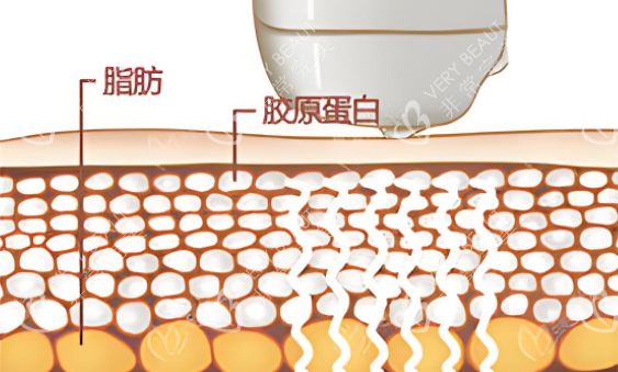 激光溶脂图