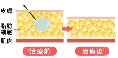 注射溶脂原理卡通图展示