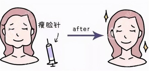 瘦脸注射前后卡通
