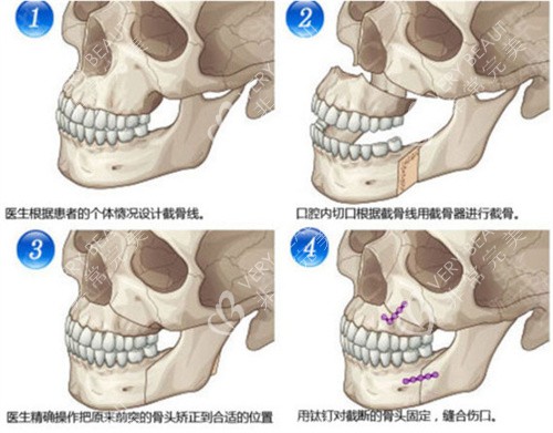 下颌骨矢状劈开术手术步骤演示图