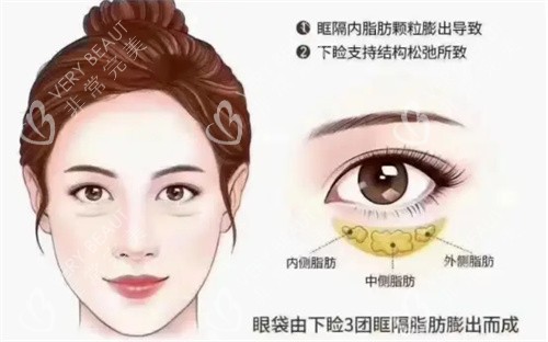 眼袋详细介绍动画图