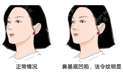 鼻基底凹陷法令纹明显