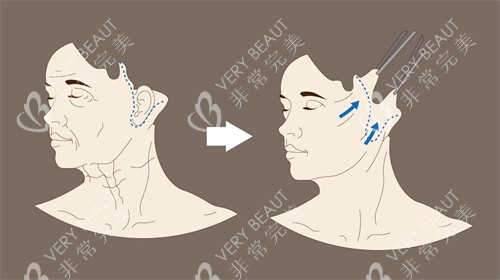 袁强面部拉皮方式动画演示图