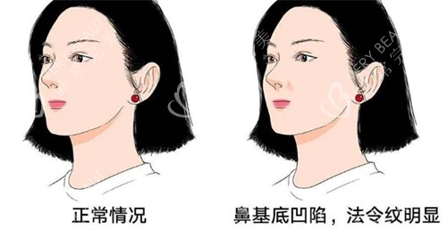 正常鼻基底和凹陷鼻基底