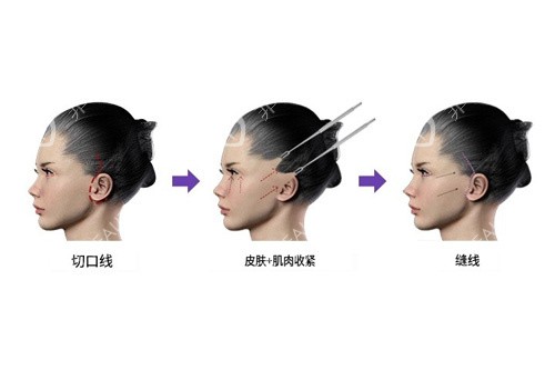 拉皮手术模拟图