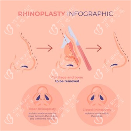鼻整形过程