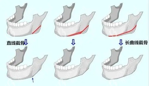 下颌骨截骨整形卡通示意图