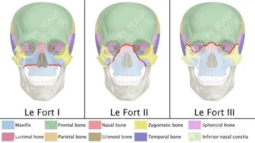 Le Fort三种手术方式演示图
