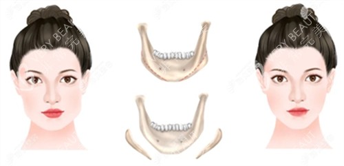 下颌骨截取手术前后对比图