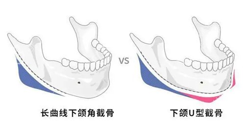 下颌角截骨位置示意图