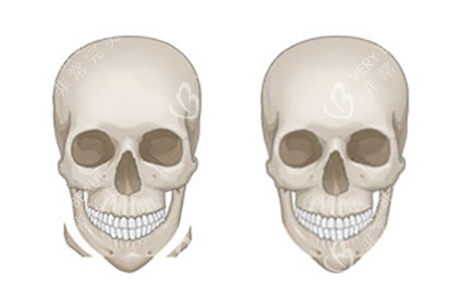 下颌削骨示意图