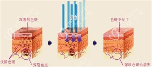 激光祛斑前后对比