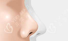 鼻整形手术宣传图