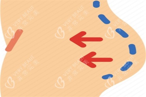 吸脂手术卡通图