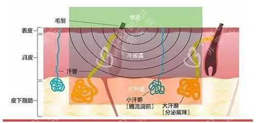 除腋臭原理图