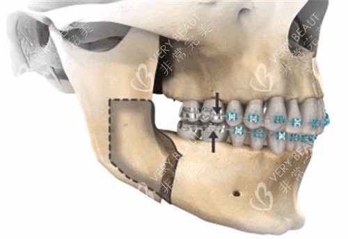 正颌手术示意图