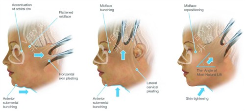 拉皮手术不同角度