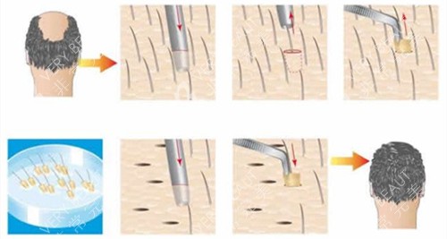 毛囊移植步骤动画演示图