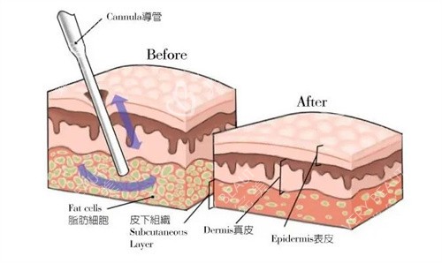 吸脂手术