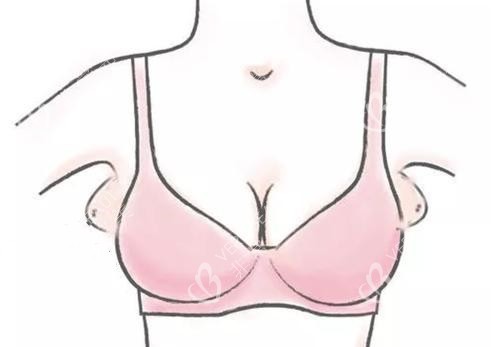 副乳位置卡通示意图
