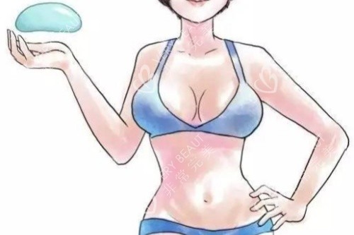 康宁假体假体丰胸卡通图