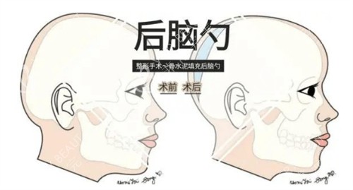 后脑勺填充对比