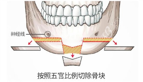T型截骨术手术演示动画图