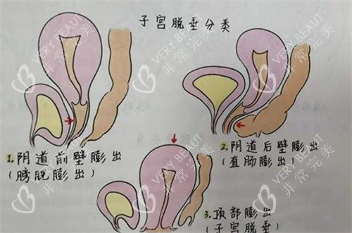 子宫脱垂的不同程度展现