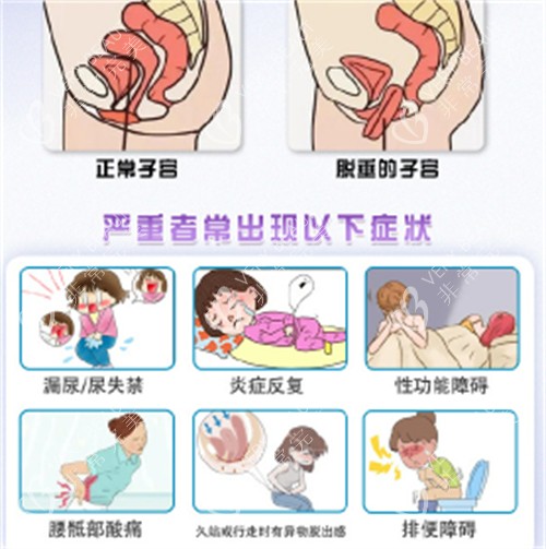 子宫脱垂的症状