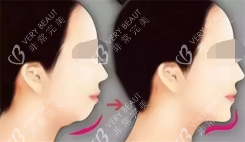 玻尿酸丰下巴后的成效