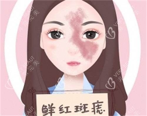 什么是鲜红斑痣