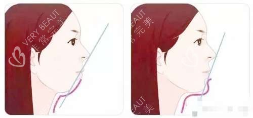 深覆合矫正前后脸型对比图