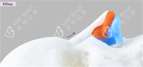 FITme3D鼻假体材料展示图