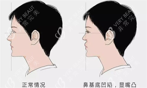 鼻基底凹陷VS面中凹陷:一文看懂两者区别与改善方法-非常完美